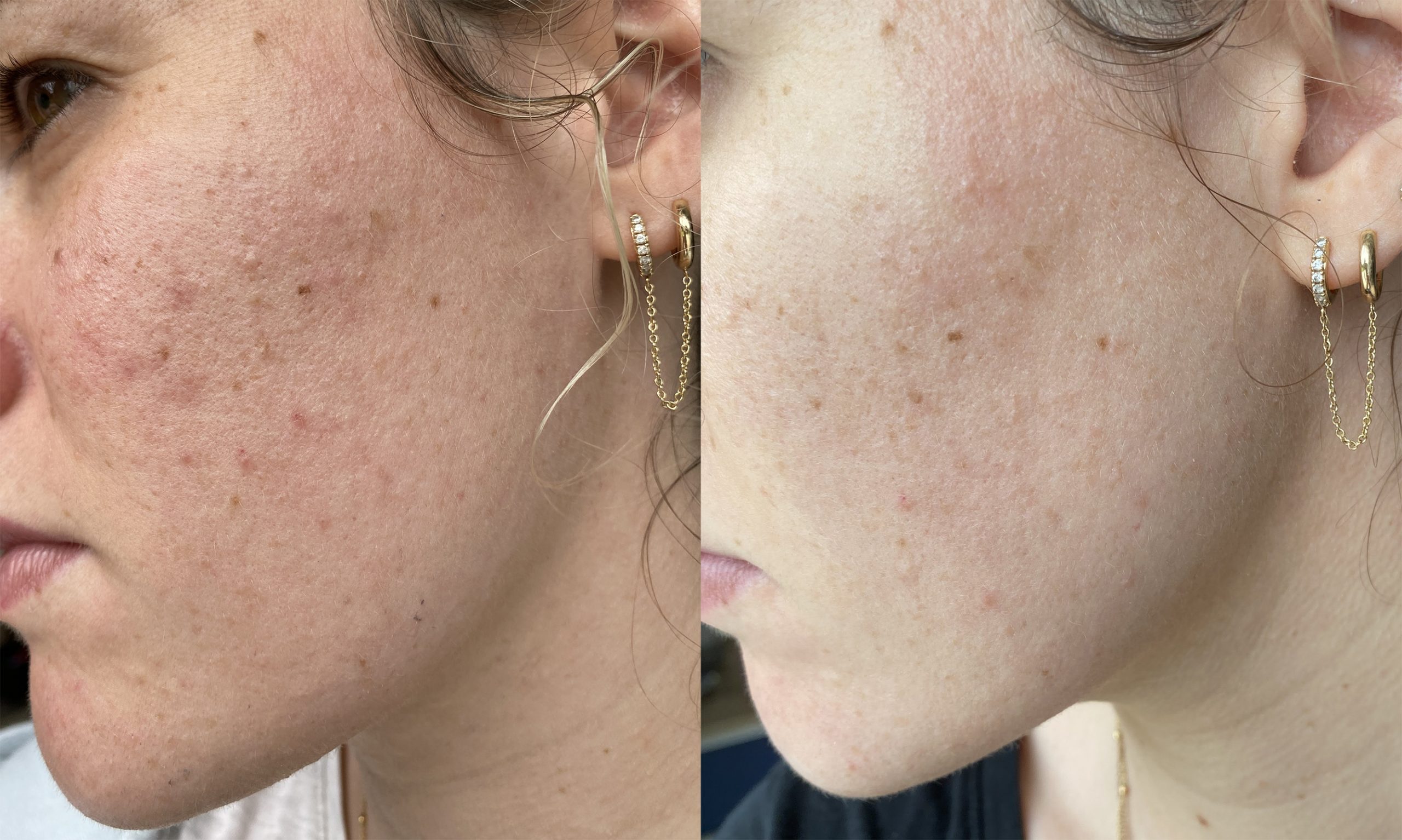 J'ai testé le Microneedling & BB glow